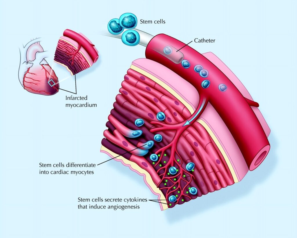 Stem Cells in Heart Conditions